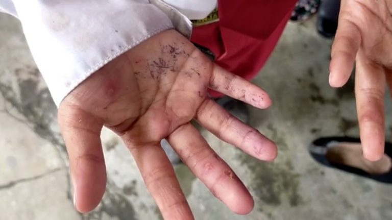 Puluhan Siswa SDN Alalak Utara 3 Diduga Tertular Scabies